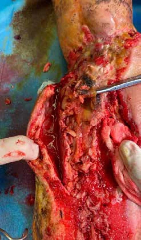 Necrotizující fasciitis (masožravé bakterie). Bakteriální toxiny ničí kůži, svaly a další měkké tkáně.