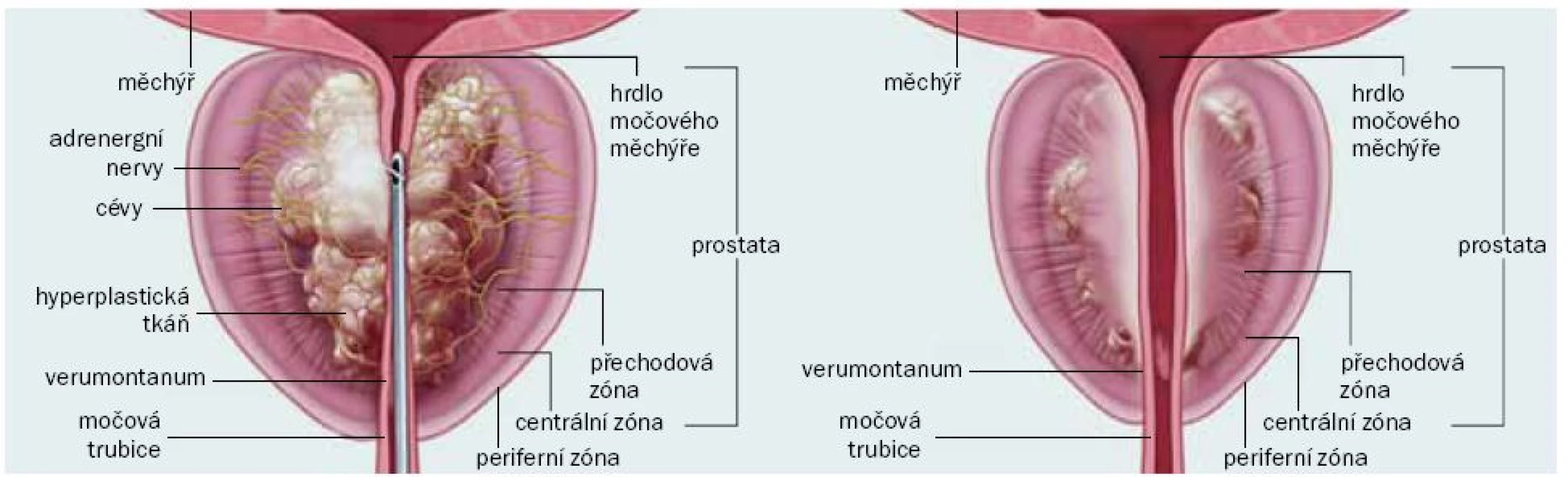 Schéma zón termických lézí po ošetření BPh pomocí Rezūm™ System.