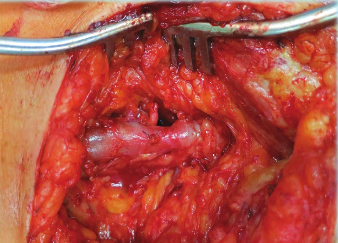 Stav po resekci výdutě a venorafii
Fig. 4: Situation after resection of the aneurysm and venorrhaphy