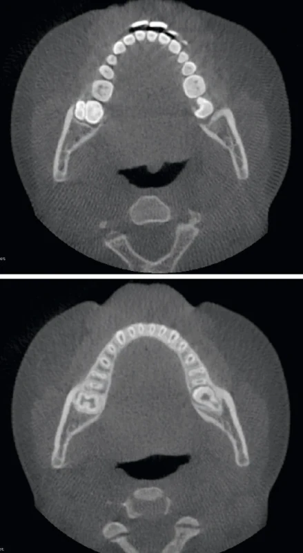 Vývojová anomálie zubu 47 na CBCT (horizontální řezy dolní čelistí). Zdroj: Dokumentace pacientky. Fig. 5a, b Developmental anomaly of tooth 47 on CBCT (horizontal sections of the lower jaw). Source: Patient’s medical documentation.