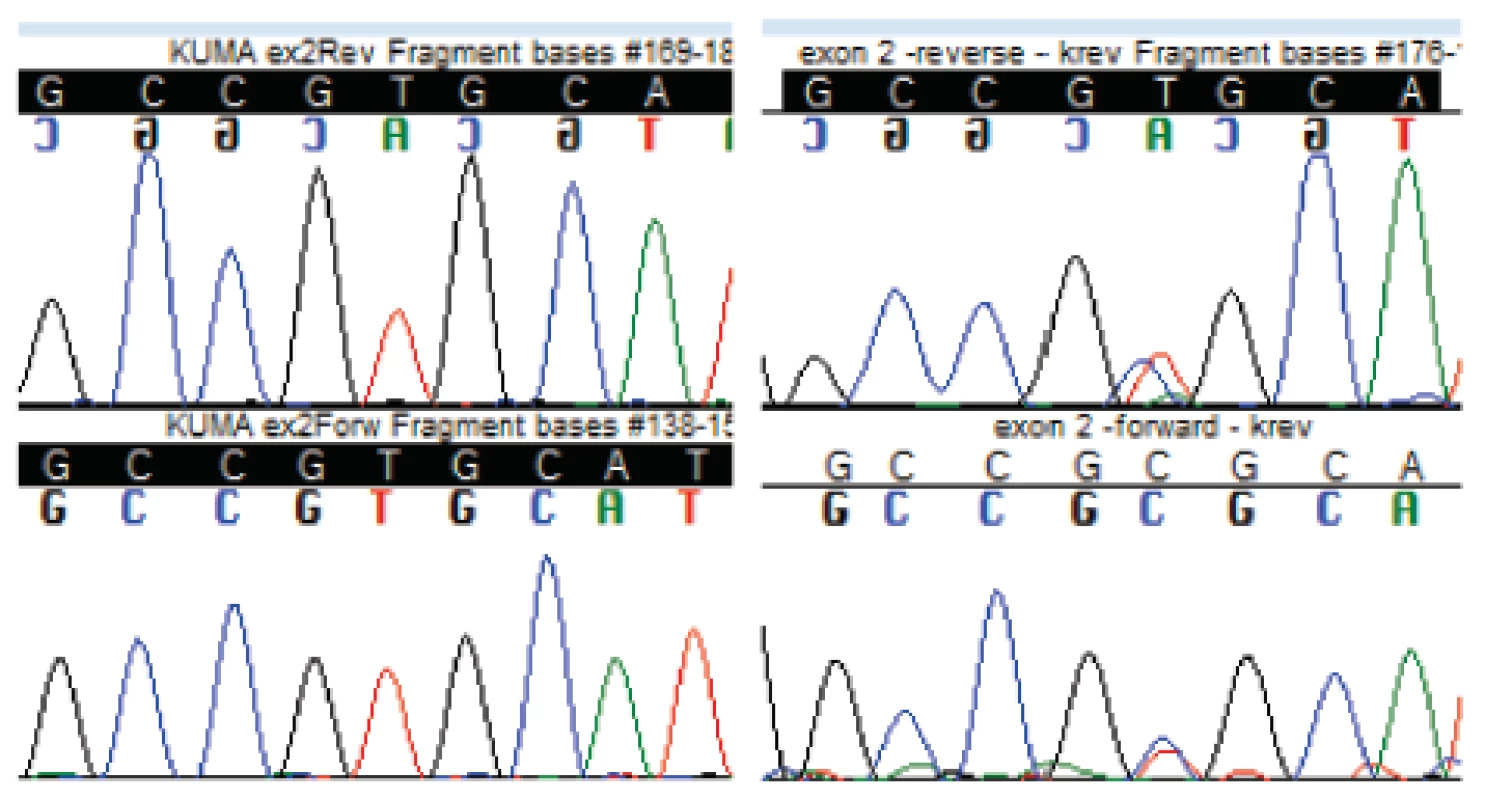 Výstupní sekvenační data z genetické analýzy u pacientů s podezřením na ATTR amyloidózu. Chromatogram s přítomností mutace Val30Ala (GTG→GCG na pozici 149 v exonu 2), mutovaná je jedna z alel, tedy pacient je v tomto případě heterozygot.
