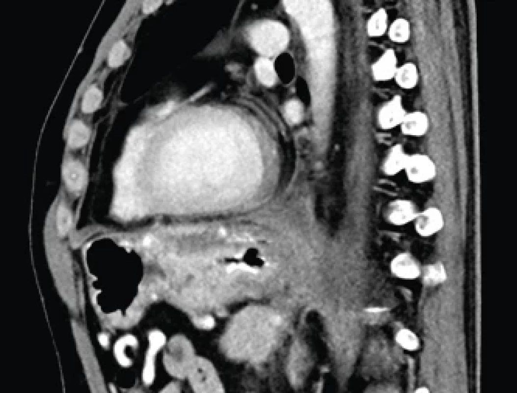 CT snímek hrudníku – pseudocysta mediastina po drenáži – sagitální rekonstrukce.