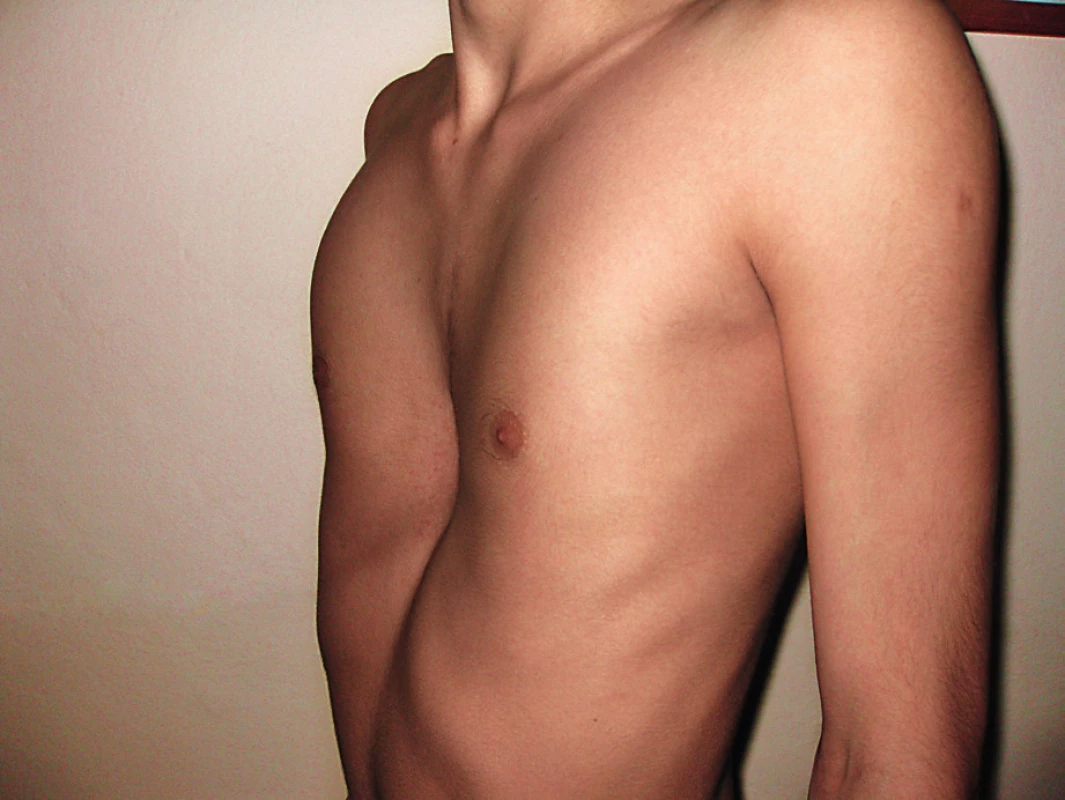 Vpáčený hrudník u 17letého chlapce.
Fig. 5. Pectus excavatum in a 17-year boy.