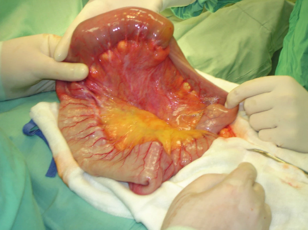 Jejunum po dezinvaginaci
Fig. 5. Desinvaginated jejunum