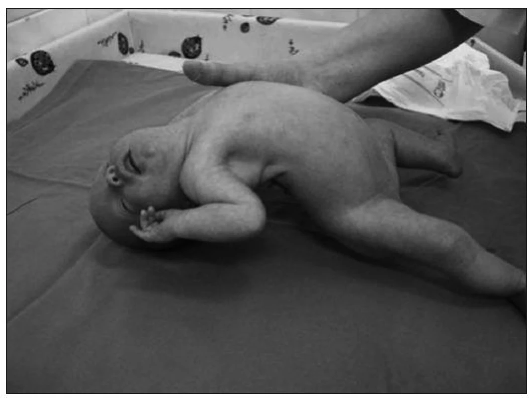 Kazuistika 1. Predčasne narodené dievčatko s PWS, ťažká globálna hypotónia.
Fig. 1. Case report 1. A premature born girl with PWS, severe global hypotonia.