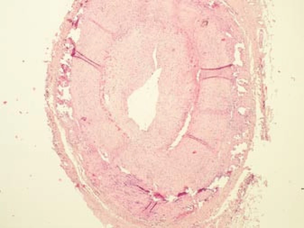 Histopatologický nález: lumen větve temporální arterie je výrazně zúženo z důvodu proliferace intimy a nasedající intraarteriální trombózy v místech aktivního zánětu. Barvení HE, 40krát.