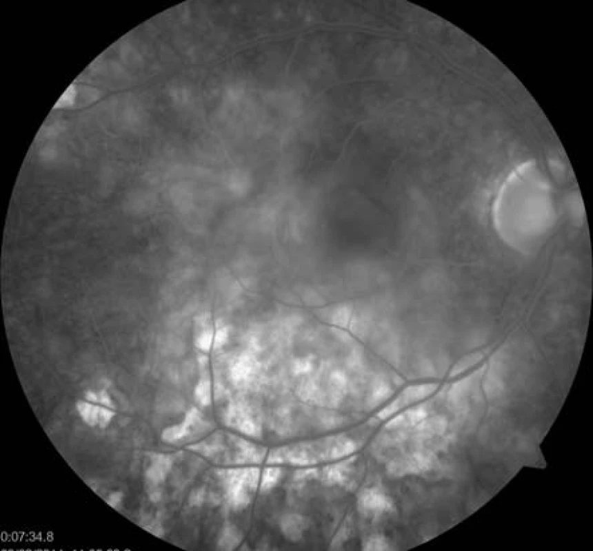 FAG oka pravého. Splývající hyperfluorescence aktivních ložisek, hyperfluorescence window defektů RPE v místě již neaktivních pozánětlivých lézí.