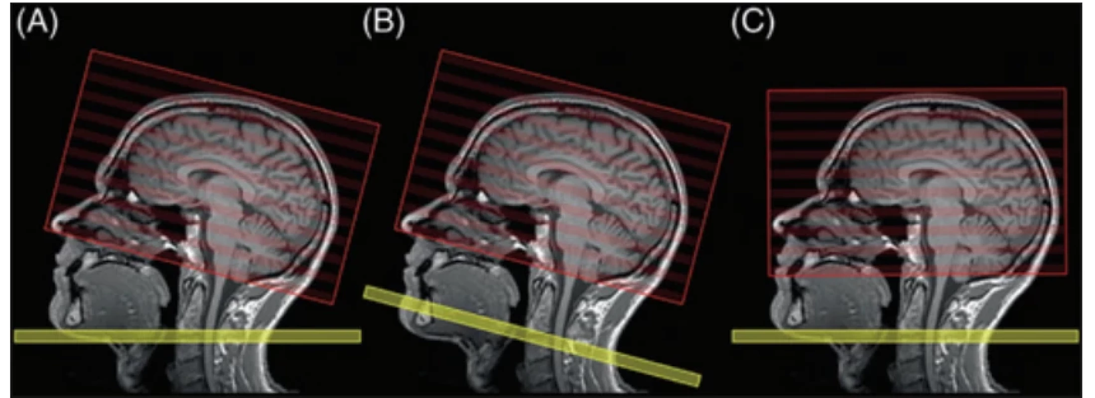 Plánování sekvence arterial spin labeling. V (A) je značící rovinu (žlutá) a skenovací objem (červený) možné volně nastavovat.
V tomto ideálním případě by měla být značící rovina umístěna kolmo na karotické tepny v oblasti C2/C3 a skenovací objem podél linie AC-PC v souladu s jinými používanými transverzálními sekvencemi. V (B) a (C) není možné značící rovinou a obrazovým objemem
jednotlivě pohybovat. V (B) odpovídá orientace obrazového objemu standardní orientaci (tj. linii AC-PC) a může být snadněji porovnávána s jinými konvenčními sekvencemi MR. Nicméně musí se počítat se případnou falešnou hypoperfuzi způsobenou odlišnou účinností značení mezi přední a zadní cirkulací. V (C) se orientace obrazového objemu odchyluje od linie AC-PC, ale účinnost značení by
měla zůstat optimální. Ideálně by měla být použita možnost (A), jinak rozhodnutí mezi (B) a (C) závisí na záměru konkrétního případu.
Obrázek je převzatý se svolením autora [5]. Planning arterial spin labeling acquisition. In (A), the labeling plane (yellow) and scanning volume (red) can be adjusted

freely. Ideally, the labeling plane should be positioned perpendicular to the carotid arteries at the C2/C3 level, and the scanning vo-
lume should align with the AC-PC line, consistent with other commonly used transverse sequences. In (B) and (C), the labeling plane

and imaging volume cannot be moved individually. In (B), the orientation of the imaging volume corresponds to the standard orienta-
tion (i.e., AC-PC line) and can be more easily compared with other conventional MR sequences. However, one must account for poten-
tial false hypoperfusion caused by diff erent labeling effi ciency between the anterior and posterior circulations. In (C), the orientation

of the imaging volume deviates from the AC-PC line, but the labeling effi ciency should remain optimal. Ideally, option (A) should be
used; otherwise, the choice between (B) and (C) depends on the specifi c case‘s objectives. The fi gure is adapted with permission [5].