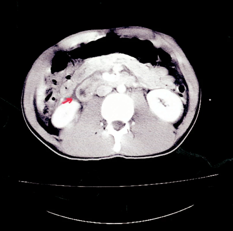 CT snímek – minimální množství tekutiny v hepatorenálním prostoru vpravo
Fig. 1. CT view – a minimum amount of fluid in the right hepatorenal region