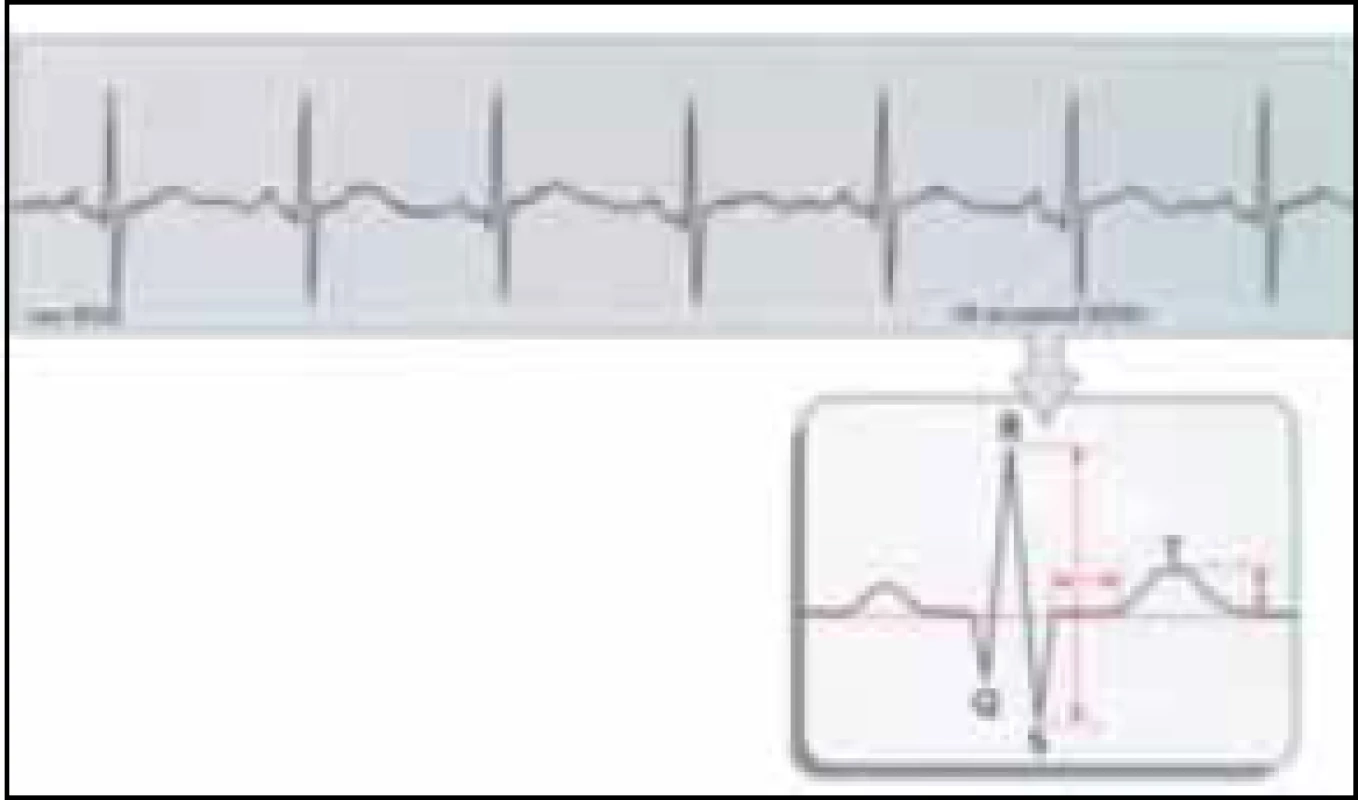 Schéma vytvoření průměrné vlny T a poměru T/QRS.