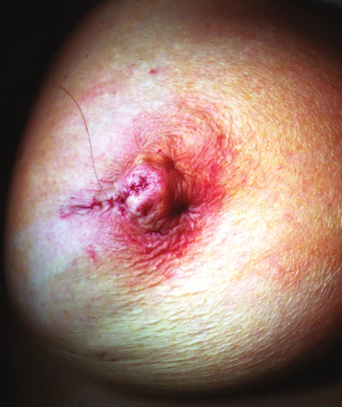 Crestinova plastika bradavky – výsledný efekt chirurgickej liečby
Fig. 3: Crestin´s plastic surgery of the nipple – the final effect of the surgical treatment