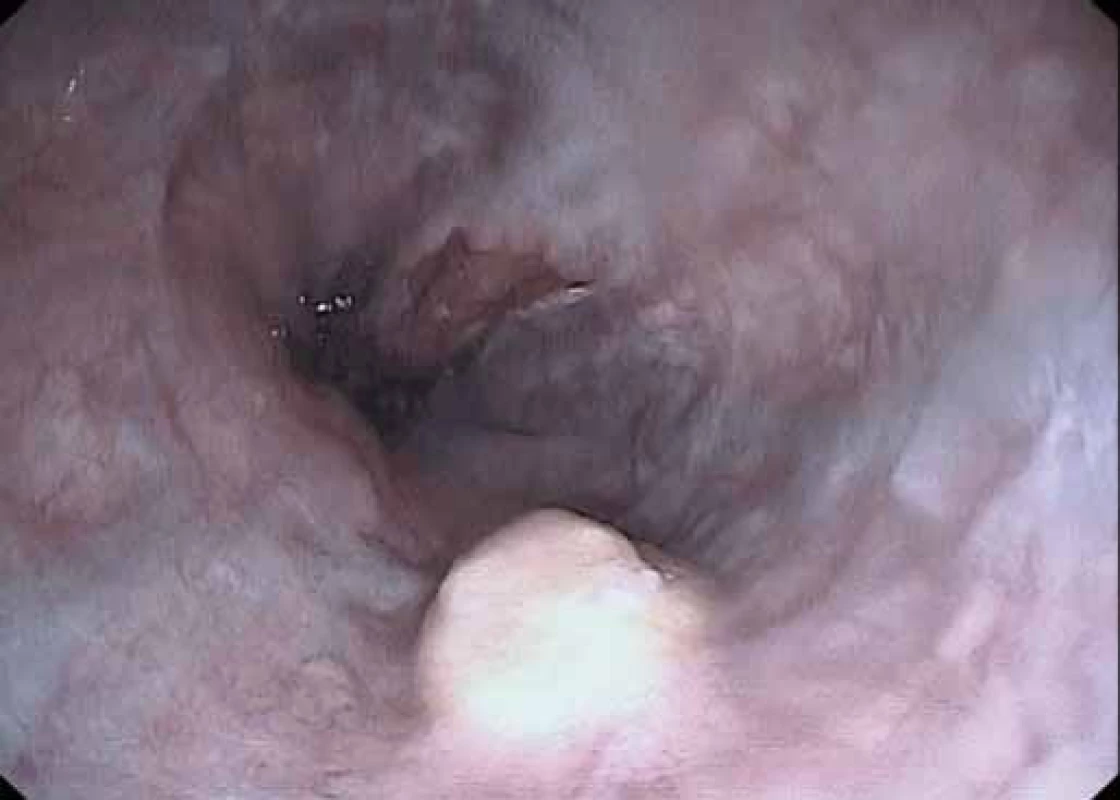Endoskopický obraz granulárnobunkového tumoru ezofagu u 49-ročného prezentovaného pacienta. Tumor mal vzhľad asi 8 mm veľkého polypoidného útvaru žltkavej farby lokalizovaného asi 2 cm nad kardiou.
Fig. 1. An endoscopic view of oesophageal granular cell tumour in the 49-year-old presented patient. The tumour appeared as a yellowish polypoid mass of aproximately 8 mm, localised 2 cm above cardia.