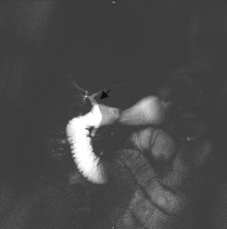 Magnetická rezonančná cholecystopankreaticografia – žlčové cesty bez výpadu kontrastnej látky
Pic. 7. Magnetic resonance cholangiopancreatography – biliary tract without contrast substance lunge