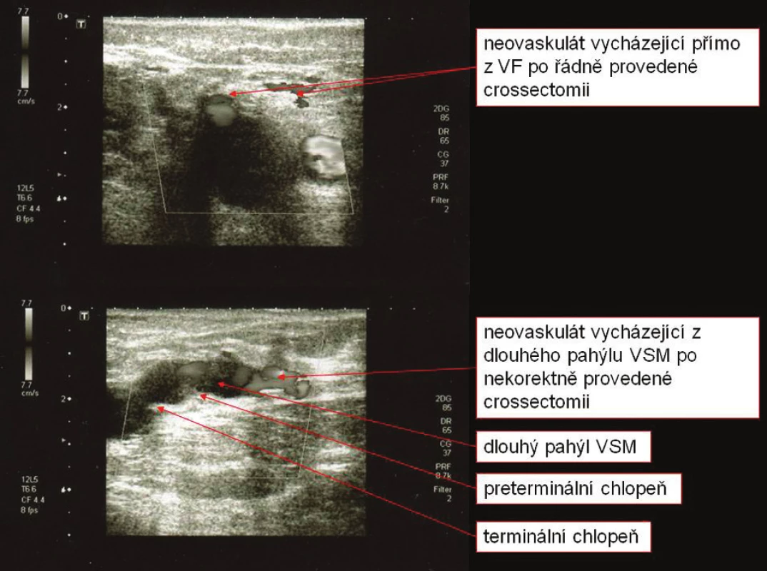 Neovaskularizace v SFJ
Fig. 7. Neovascularization in SFJ
