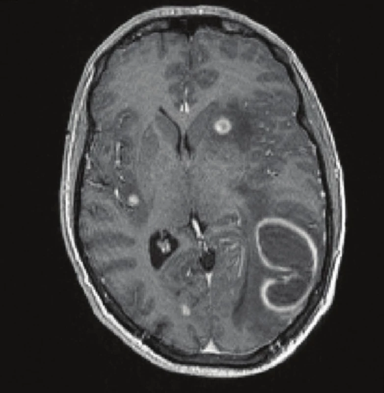 Magnetická rezonance – mnohočetné metastázy maligního melanomu do mozku
Fig. 2: Magnetic resonance imaging – multiple melanoma metastases to the brain
