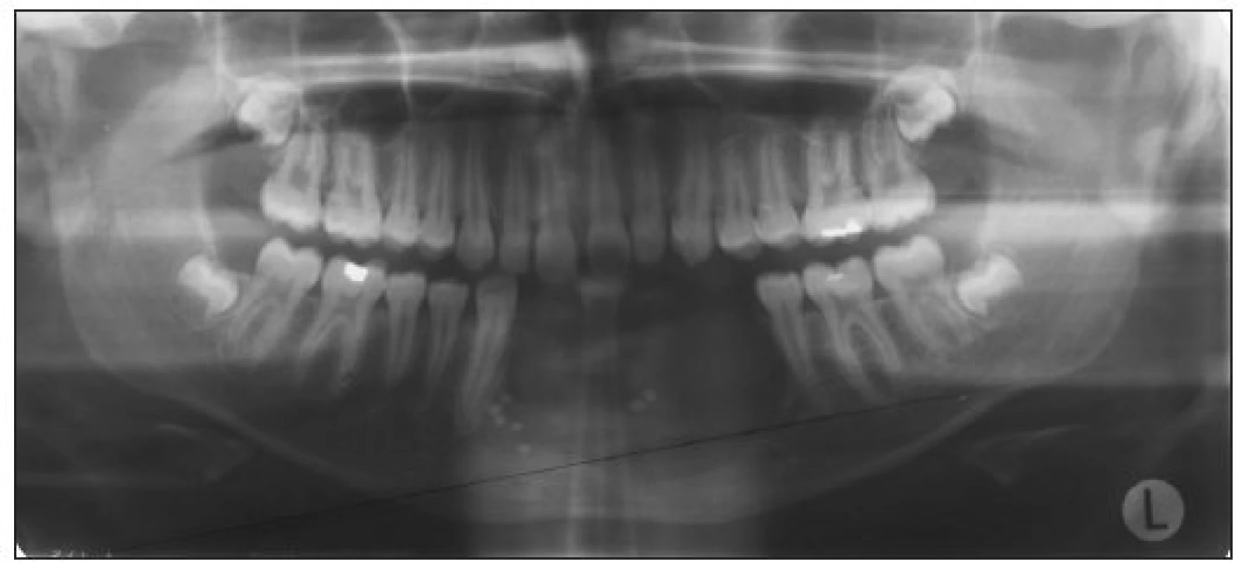 A 12-year old boy – new surgical intervention