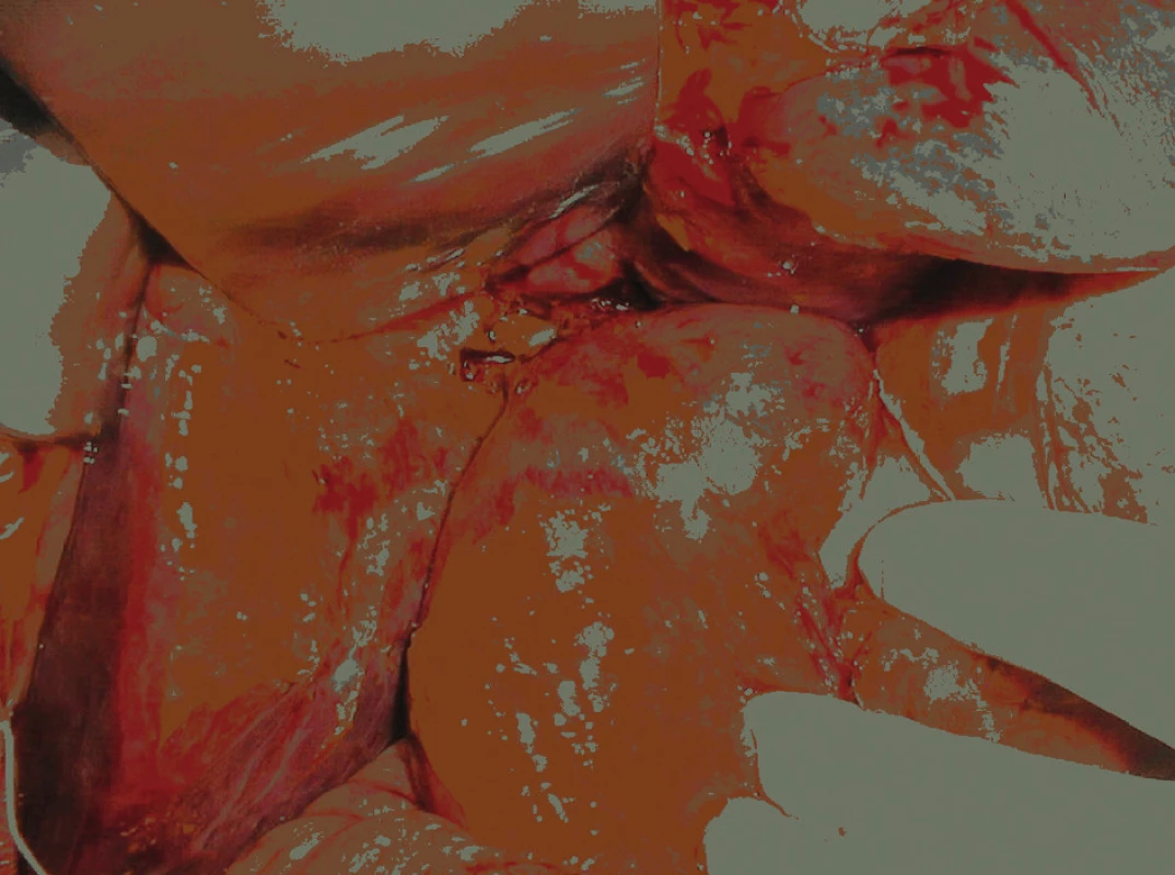Biliárna peritonitída s pablanami v oblasti, kde katéter perforoval žlčovod
Fig. 13: Biliary peritonitis in the place where the catheter perforated the bile duct