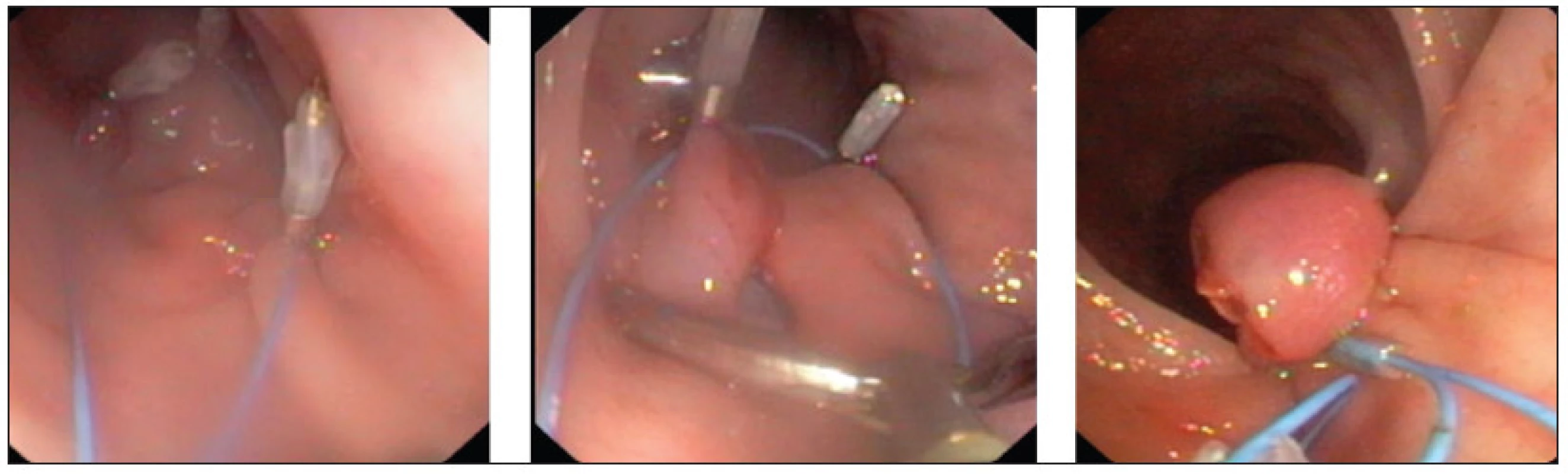 Uzávěr kolotomie s použitím endokličky a klipů (loop-and-clip, King’s closure)
Fig. 4. Single loop-and-clip rectal closure (King’s closure)