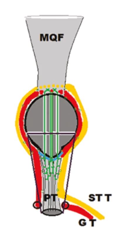 Schématické znázornenie revíznej operácie pre
  re-ruptúru <i>ligamentum patellae</i> s augmentáciou šľachami
  <i>musculus semitendinosus</i>
  (STT − žltá) a <i>musculus gracilis</i> (GT − červená). Transoseálna
reinzercia (zelená) ruptúry (modrá).<br>
  Fig. 3: Schematic illustration of the revision surgery for
patellar tendon re-rupture, using semitendinosus
  (STT − yellow) and gracilis muscle (GT − red) augmentation. Transosseous
suture (green) of the patellar ligament rupture (blue).
