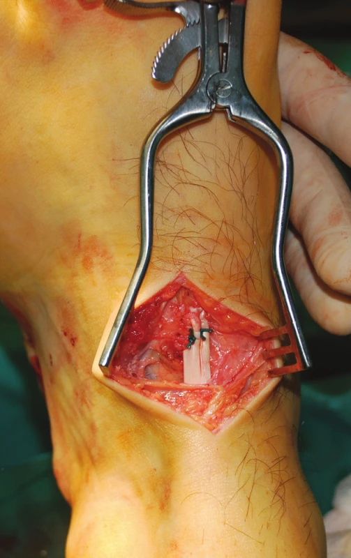 Ukotvení šlachy m. tibialis posterior do os cuneiforme laterále
Fig. 3: Anchoring the posterior tibial tendon into the lateral cuneiform bone