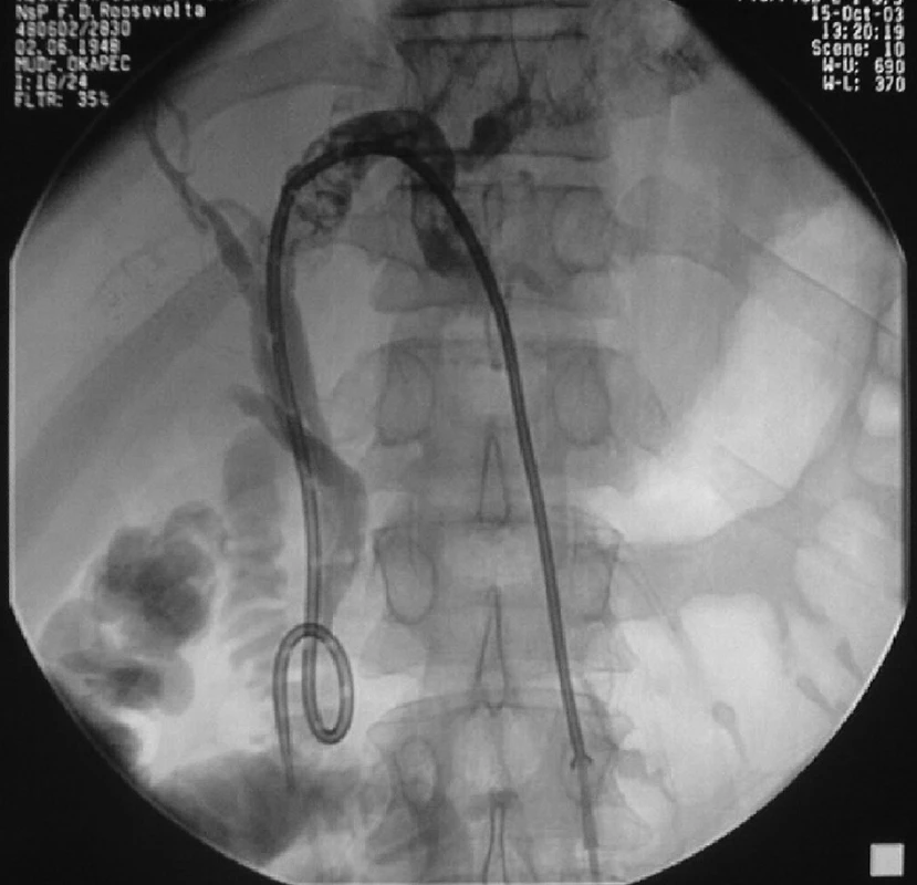 Infekcia v kameňmi vydláždenom ľavom ductus hepaticus sa pozdĺž PTD katétra rozšírila do celého drenážneho kanála a na brušnú stenu
Fig. 14: Infection in the left bile duct full of stones spread along the PTD catheter to the entire drainage canal and to the abdominal wall
