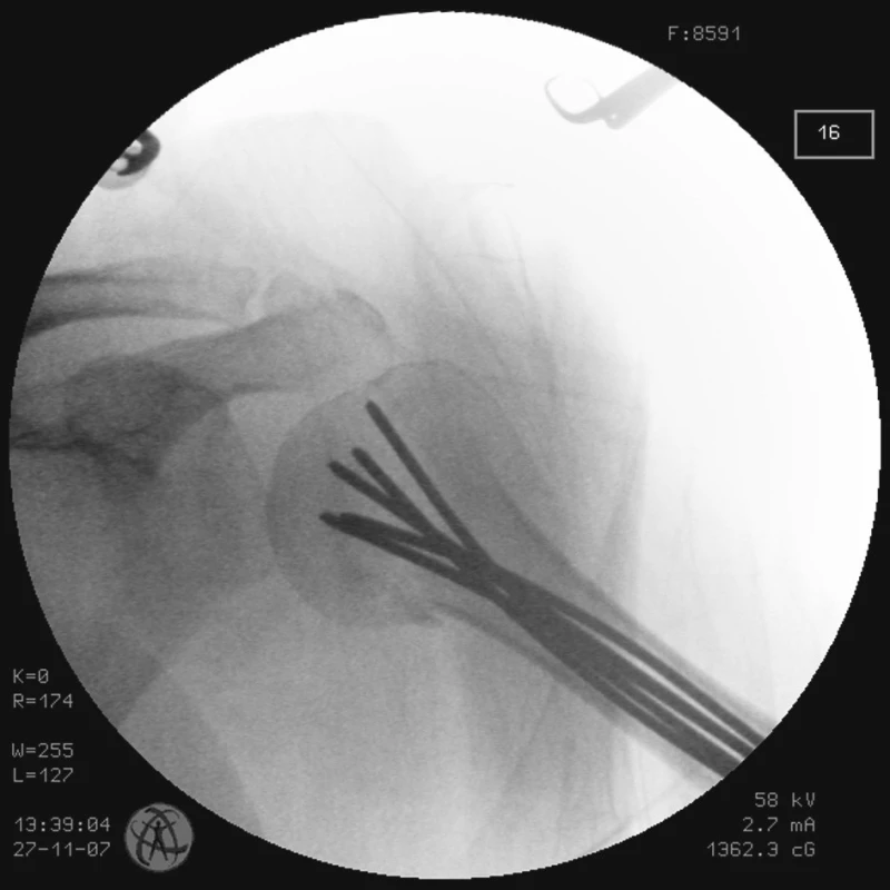 RTG obraz po transfixaci zlomeniny K-dráty vyplňujícími celou dřeňovou dutinu – stav po ukončení operace u pacienta č. 1
Fig. 3. X-ray view following the fracture transfixation with K- wires filling the whole medullar cavity – the patient No. 1 condition after completion of the procedure