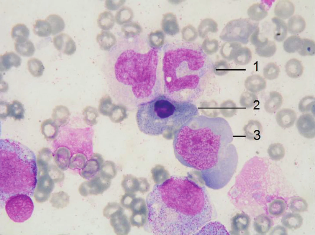Obraz megaloblastické přestavby kostní dřeně u našeho nemocného – gigantická tyč (1), megaloblast ortochromní s bazofilním tečkováním (2), megaloblast polychromní (3), barvení May-Grünwald Giemsa, zvětšení 1000 x