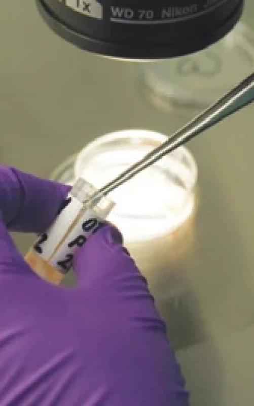 Přesun ovariální tkáně do zkumavek pro následnou kryokonzervaci. Fig. 5. Transfer of ovarian tissue to test tubes for subsequent cryopreservation.