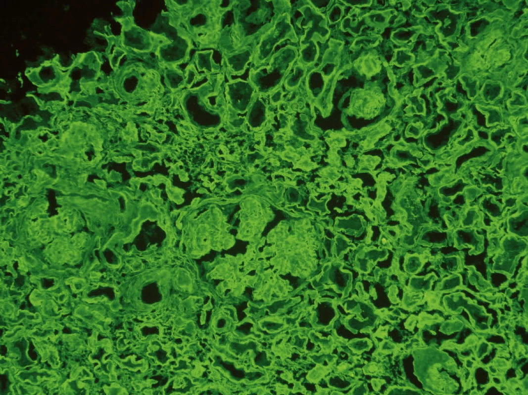 Biopsie ledviny – imunofluoresenční průkaz depozit &amp;kappa; řetězců.