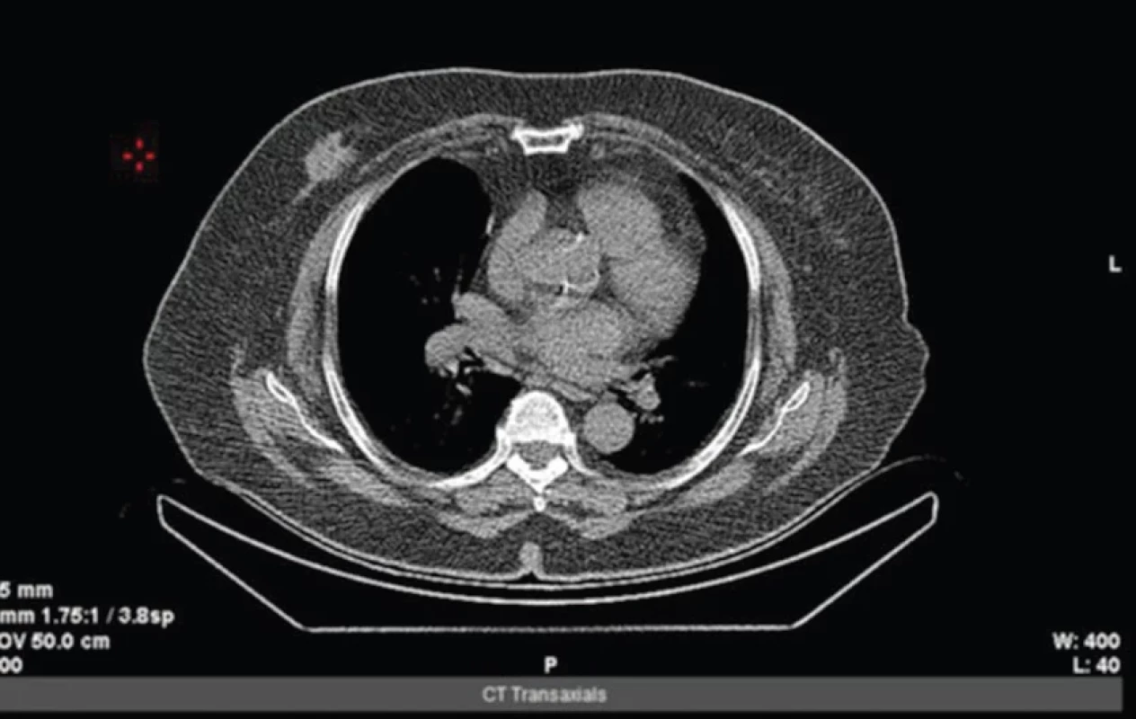 Low dose CT hrudníku – axiální řez v měkkotkáňovém okně – v pravém prsu je patrné ložisko.