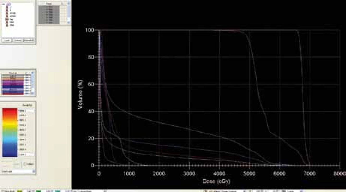 Dose-volume histogram bez použití ABC zařízení.
