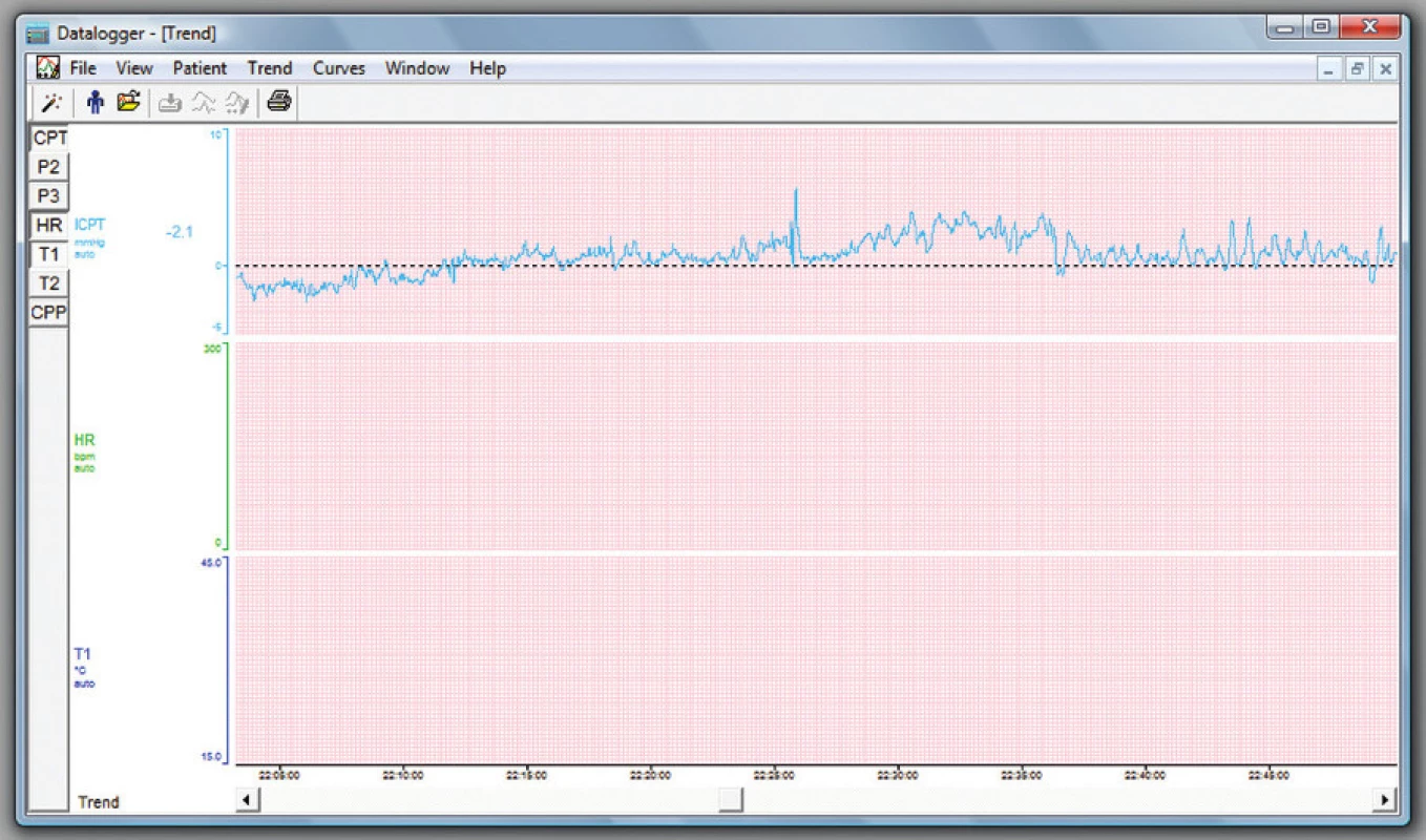Znázornění ICP křivky v programu Raumedic Datalogger Vers. 1.7
Fig. 5: Representation of the ICP curve in the Raumedic Datalogger Vers. 1.7 software