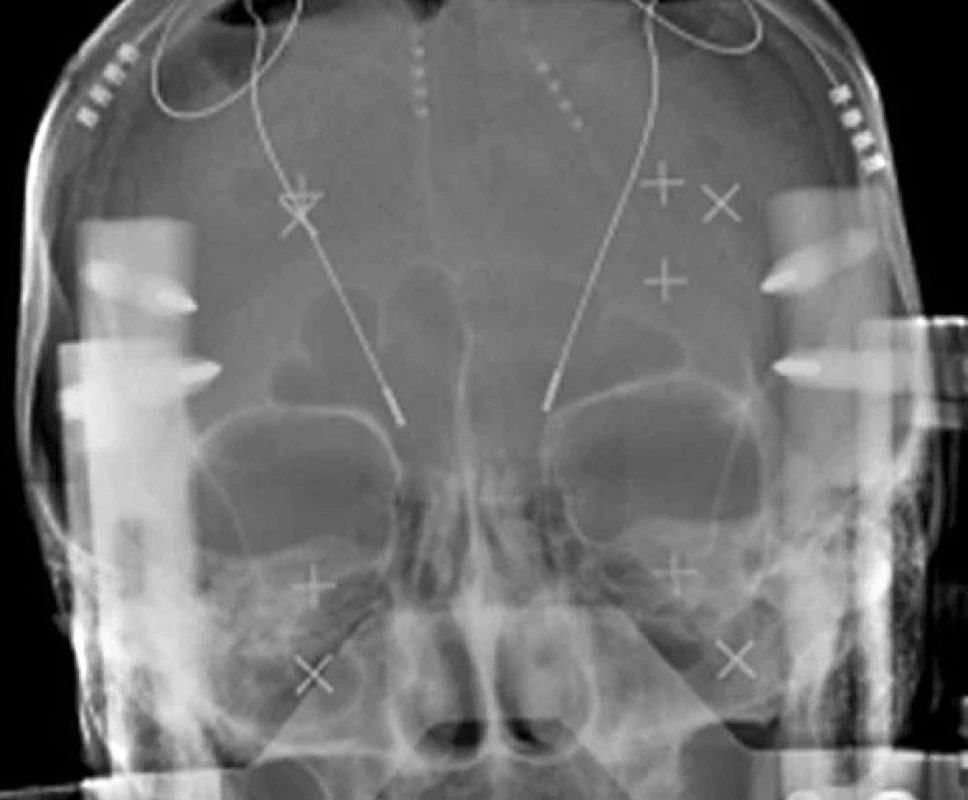 RTG zobrazení intracerebrálních elektrod