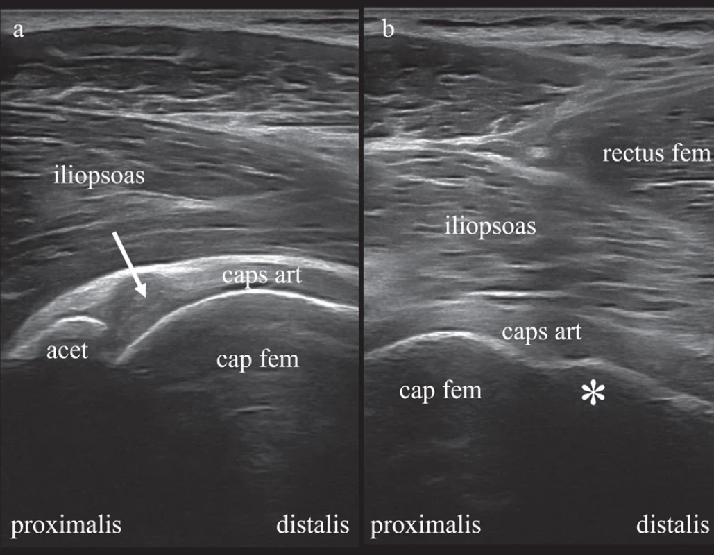 Sonogram kyčelního kloubu s nálezem: a – otoku acetabulárního labra,  b – CAM léze. Fig. 6. Sonogram of the hip joint showing: a – swelling of the acetabular labrum,  b – CAM lesion.