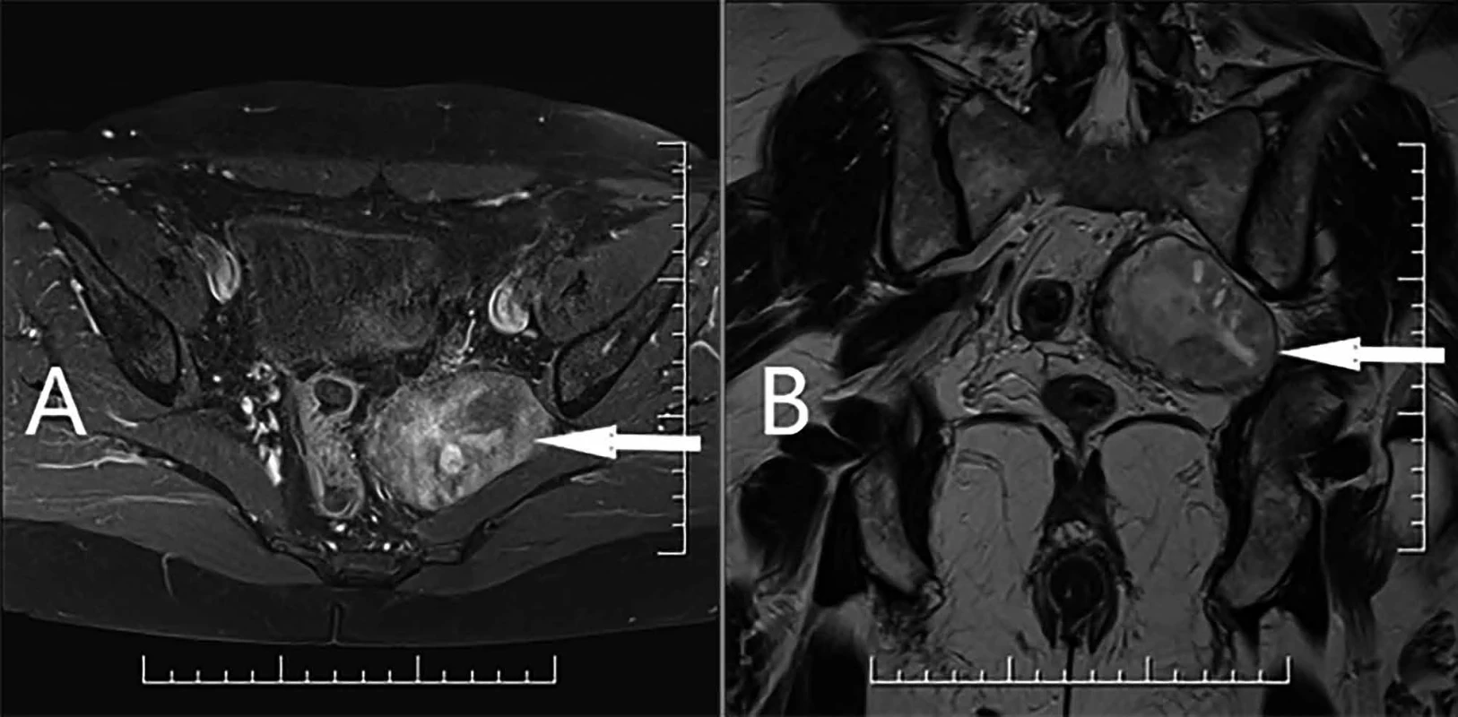 A : MR axiální řez malé pánve, šipka označuje presakrálně uložený ohraničený tumor vlevo (T1 − vážená sekvence, TSE, gadovist); B: MR koronární řez malé pánve, šipka označuje presakrálně uložený tumor vlevo (T2 − vážená sekvence, TSE)