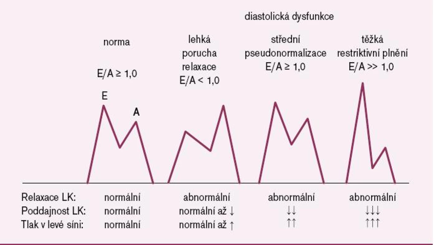Charakter transmitrální dopplerovské křivky při diastolické dysfunkci levé komory.