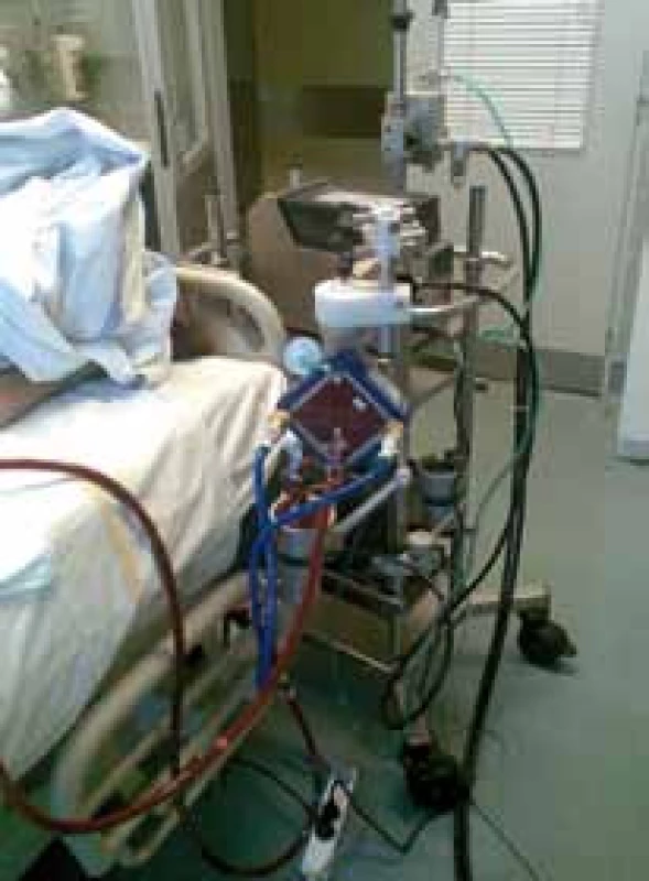 Perkutánní koronární intervence s podporou veno‑arteriálního ECMO (panel A), detail na zavedené kanyly do třísel (panel B, stejný pacient jako na panelu A) a celý systém u lůžka intenzivní péče (panel C). Systém PLS – permanent life support (Maquet, Germany).