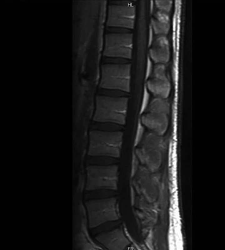 Kontrola po 2 měsících od začátku onemocnění.
Fig. 5. Follow-up 2 months after the beginning of the disease.