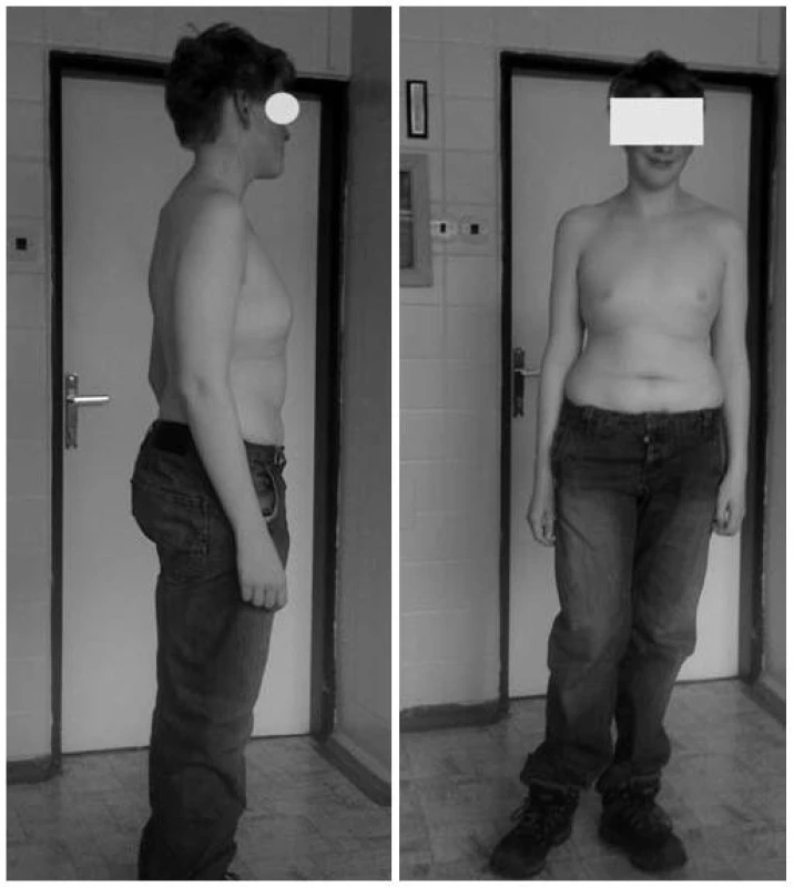 Postava chlapce po roce léčby.
Fig. 2. The figure of the boy after one year of treatment.