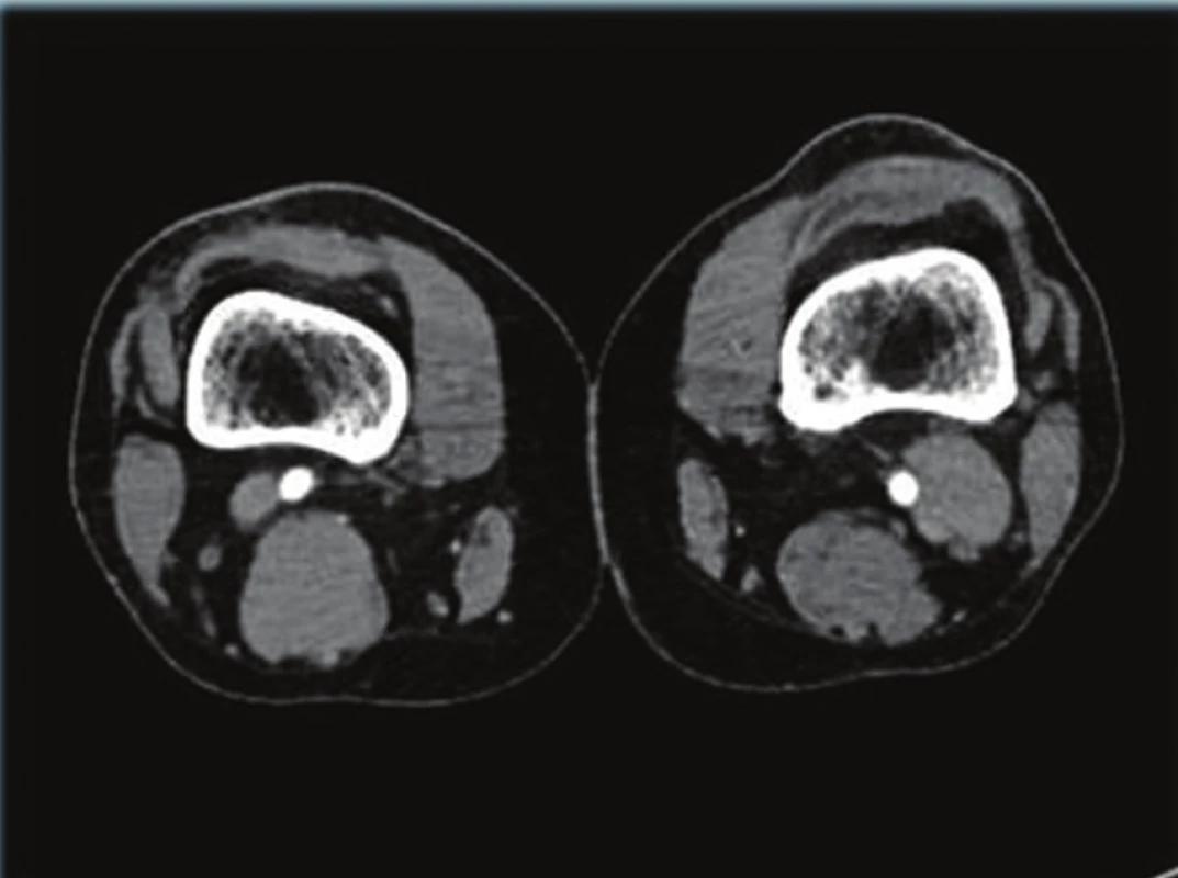 CT AG, patrné aneuryzma vena poplitea vlevo
Fig. 1: CTAG; visible aneurysm of vena poplitea sinistra