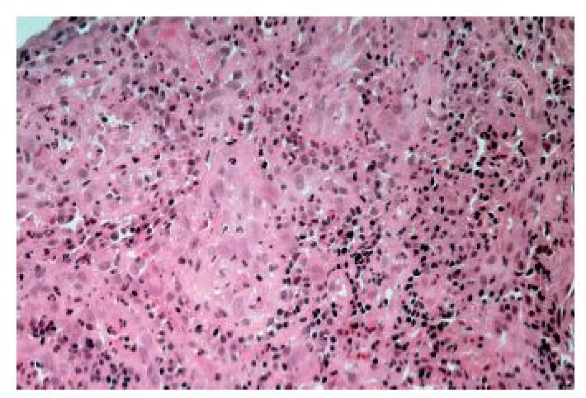 Cytomegalovirová ezofagitida. V dlaždicovém epitelu však inkluze nemusí být patrné a lze pak zastihnout pouze známky alterace a zánětlivý infiltrát (HE, 800x).