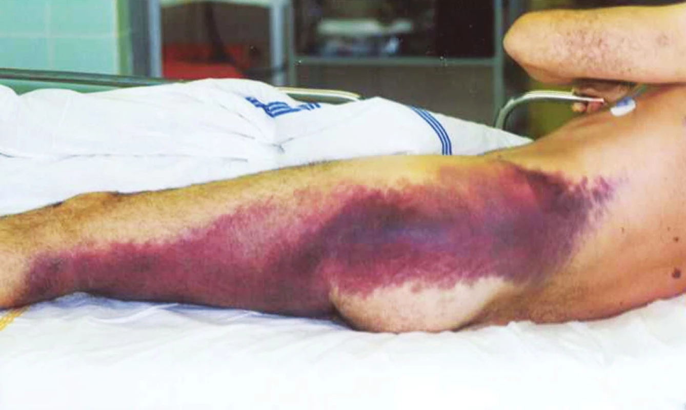Krvácení do měkkých tkání při předávkování warfarinem
Fig. 1. Soft tissue bleeding due to warfarin overdose