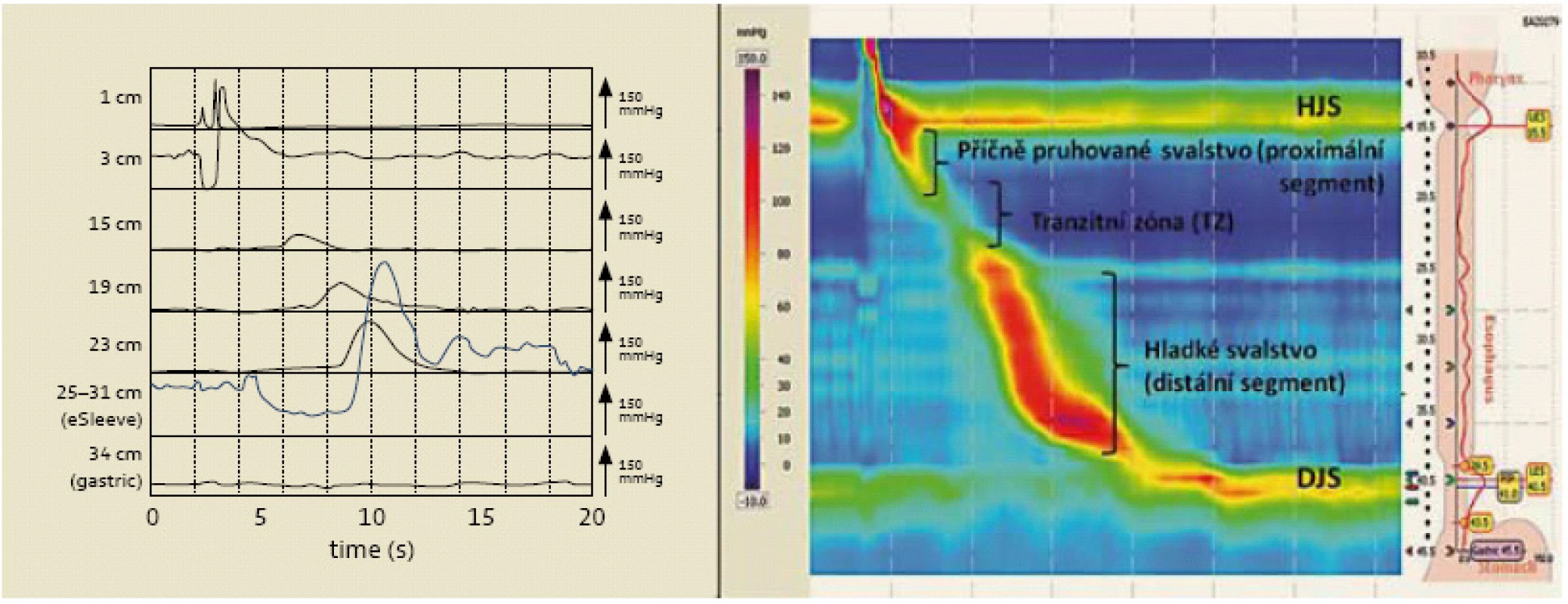 Zobrazení konvenční manometrií vs high-resolution manometrií.
Fig. 1. Visual output of conventional manometry vs high-resolution manometry.