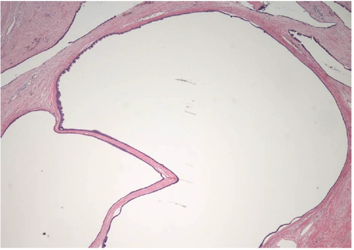Histologický nález většiny cyst – zvětšeno 20x
Fig. 3 Histological findings of most cysts – 20 x magnification