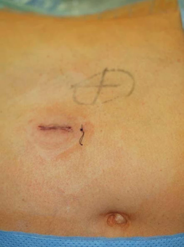 Pooperační stav – rána po jednoportové adrenalektomii pacientky BMI 28
Fig. 4. Incision after laparoendoscopic single site adrenalectomy, patient with BMI 28