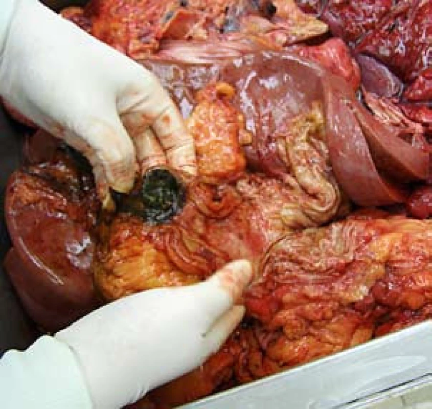 Sekční nález velké metastázy maligního melanomu v bulbu duodena.
Fig. 3. Sectional finding of a large metastasis of malignant melanoma in the duodenal bulb.