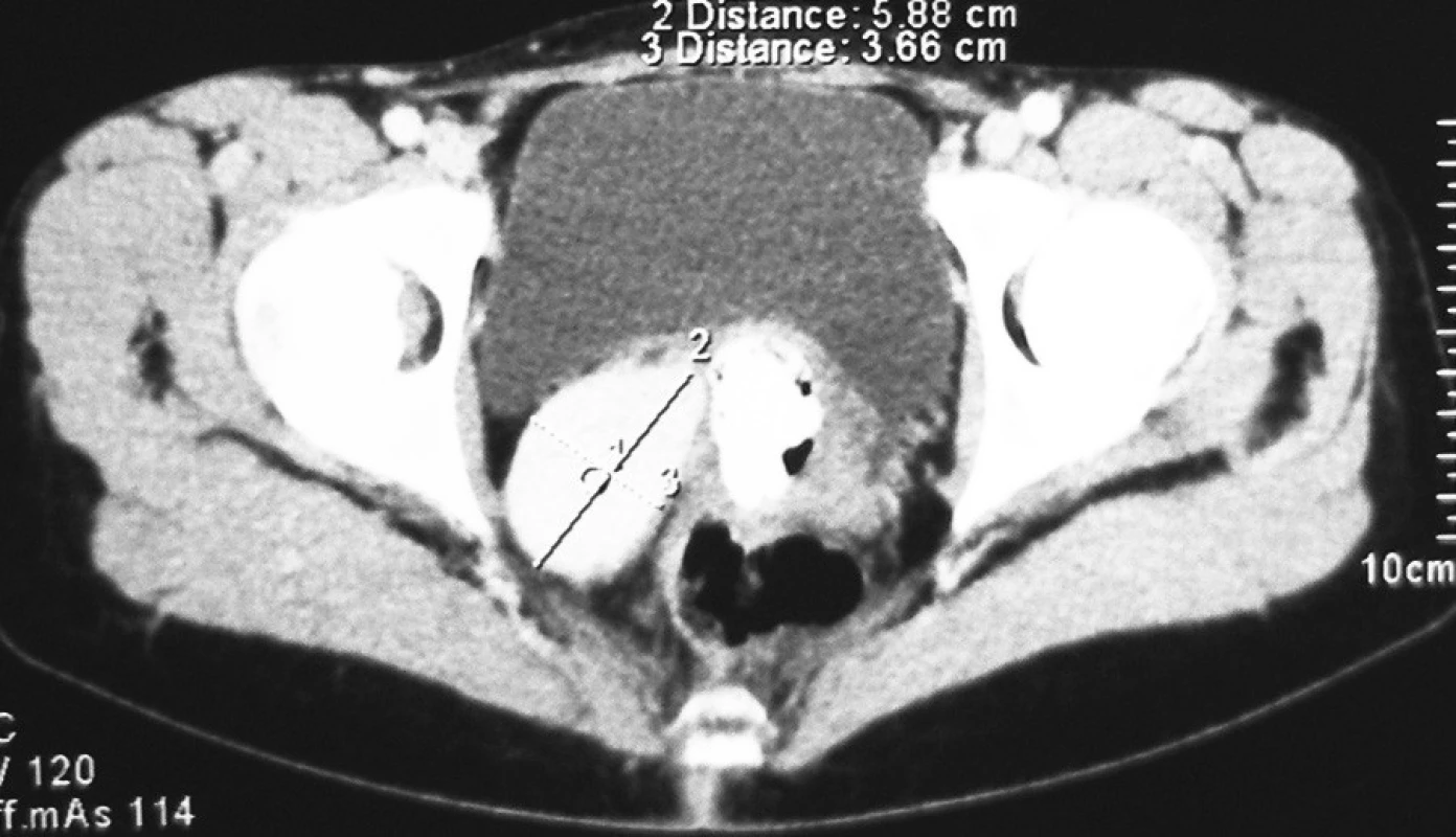 Pacient č. 2. CT obraz aneuryzmy arteria iliaca interna vpravo
Pic. 3. Patient Nr. 2: A CT scan of the internal iliac artery aneurysm on the right