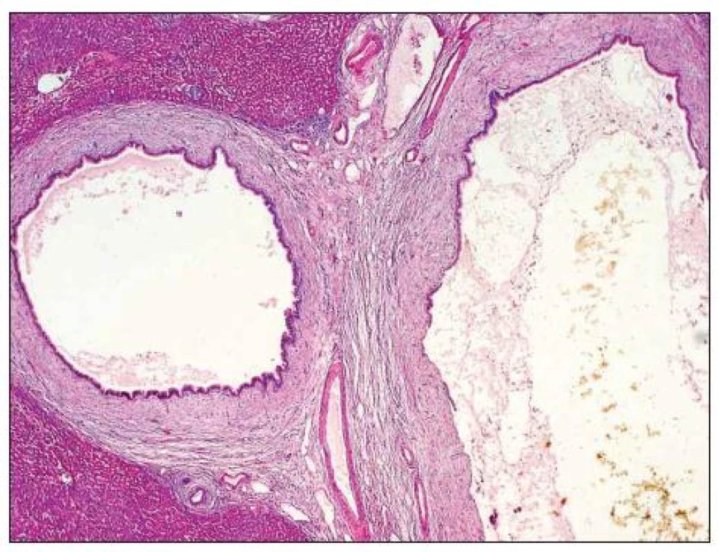 Masivní dilatace žlučových cest s agregáty mikrofágů obsahujících žlučový pigment s přítomností periduktální fibrózy. HE, zvětšeno 100x
Fig. 6. Massive dilatation of the biliary tract with aggregates of macrophages containing bile pigment and periductal fibrosis. HE, magnification 100x