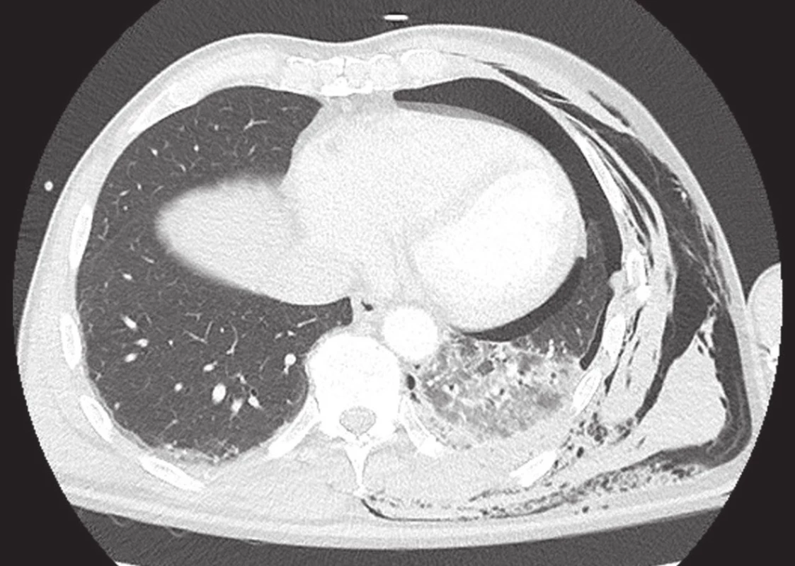 Rozsáhlá plicní kontuze v levém dolním laloku se sdruženým poraněním hrudníku
Fig. 1: Extensive pulmonary contusion in the left lower lobe with chest wall injury