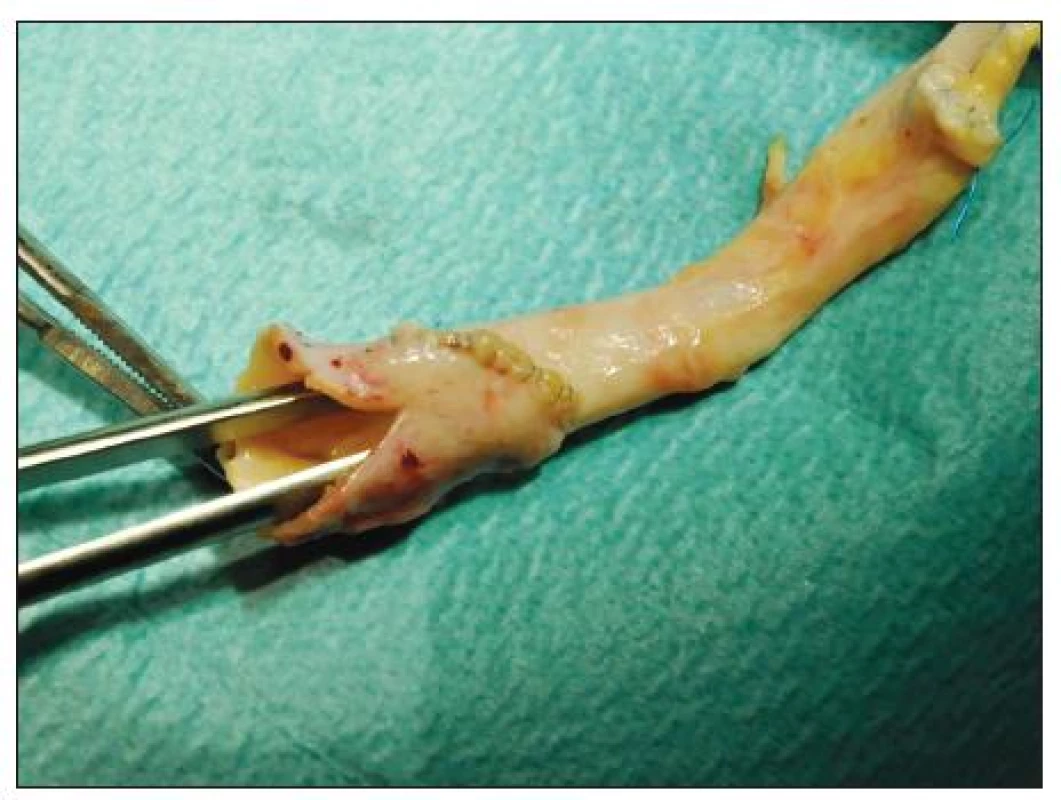 Dilatační plastika hrdla TAG s pomocí synarterializace odstupů společných pánevních tepen a nastřižením společného ústí
Fig. 4. Dilating arterioplasty of the TAG using synarterialization of the common iliac arteries and partial incision of the common trunk